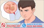 Có nên điều trị sùi mào gà tại nhà không?