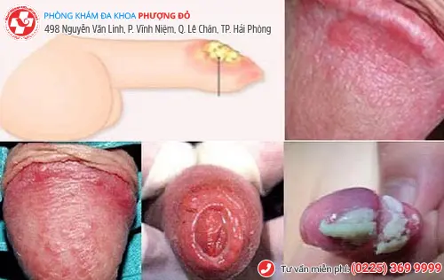 Bệnh về bao quy đầu ở nam giới