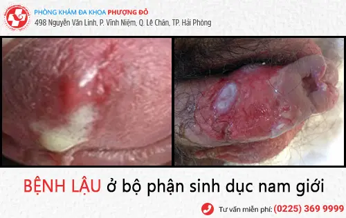 Chảy mủ đầu dương vật, dương vật nặng mùi - Dấu hiệu bệnh lậu