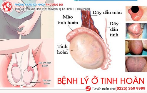 1 số triệu chứng bệnh tinh hoàn cần đi khám ngay