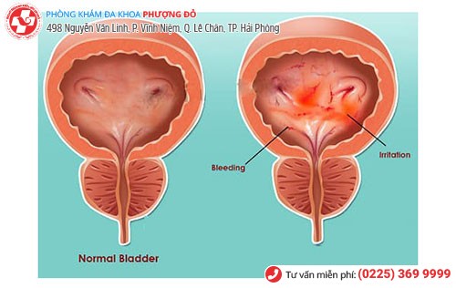 Hình ảnh bàng quang bị viêm