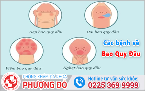 Các bệnh liên quan về bao quy đầu