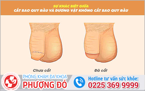 Cách điều trị các bệnh về bao quy đầu