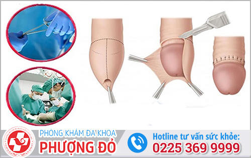 Cắt bao quy đầu là gì? 