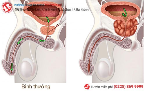 Phì đại tuyến tiền liệt gây ra sỏi tuyến tiền liệt