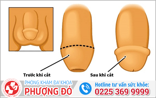 Lưu ý trước và sau khi đi cắt bao quy đầu tại Phượng Đỏ