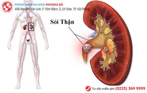 Hình ảnh sỏi bàng quang