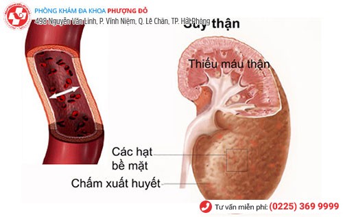 Nguy cơ suy thận do viêm niệu đạo