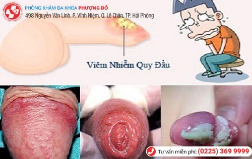 Viêm bao quy đầu do chưa lột bao quy đầu