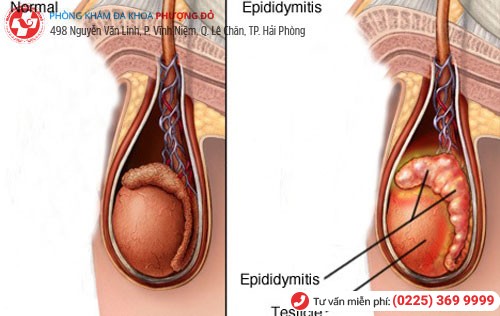 Viêm mào tinh hoàn tăng nguy cơ bị tràn dịch tinh hoàn
