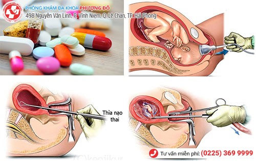 Các phương pháp bỏ thai an toàn chị em cần biết