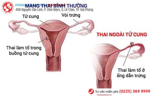 Nguy cơ mang thai ngoài tử cung do viêm vùng chậu Nguy cơ mang thai ngoài tử cung do viêm vùng chậu