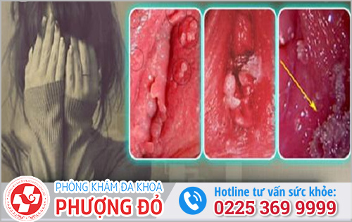 Mụn ở âm đạo là bệnh gì?