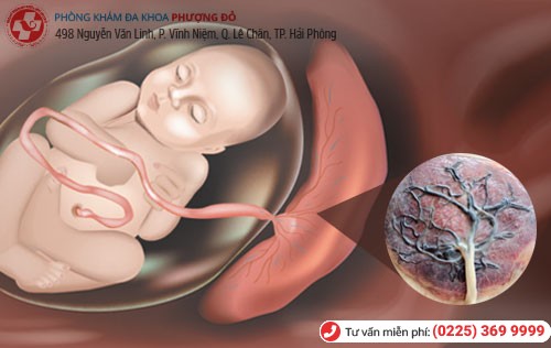 Hình ảnh nhau thai Sót nhau thai