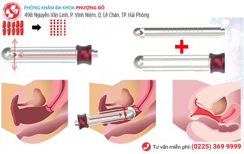 Thẩm mỹ tầng sinh môn