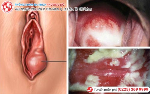 Sưng âm đạo do nấm Candida