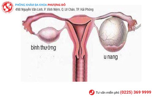 u nang buồng trứng