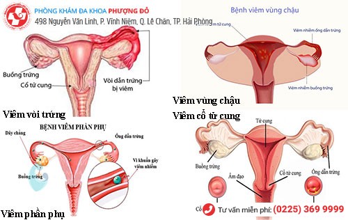 Viêm nhiễm phụ khoa