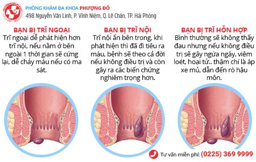 Dấu hiệu bệnh trĩ