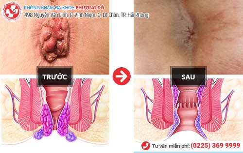 Chữa Bệnh Trĩ Nội Không Còn Là Vấn Đề Khó