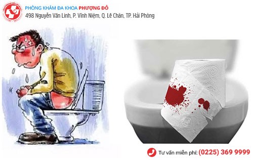 Những thông tin cần biết về bệnh trĩ nội độ 1, độ 2