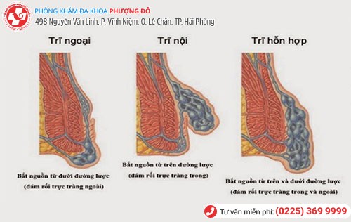 các loại bệnh trĩ