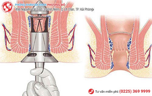 Cắt Trĩ Bằng Phương Pháp Longo Có Tốt Không ?