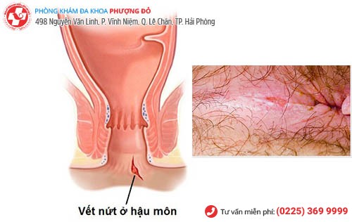 Nứt kẽ hậu môn