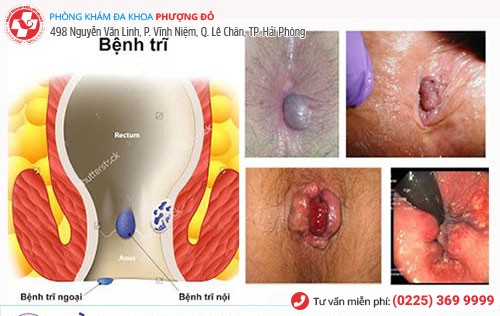 Dấu hiệu bệnh trĩ Dấu hiệu bệnh trĩ