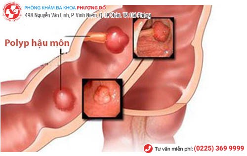 Polyp hậu môn và cách điều trị Polyp hậu môn hiệu quả