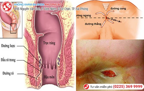 Bệnh Rò Hậu Môn