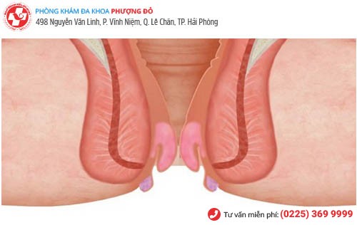 Sa búi trĩ-chữa càng sớm khỏi càng nhanh