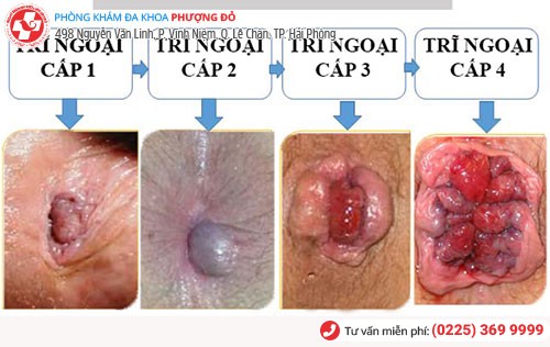 Các cấp độ trĩ ngoại