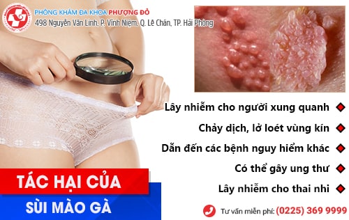 Sùi mào gà nữ và những điều cần biết