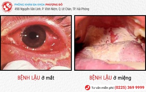 Biểu hiện bệnh lậu – đa số đều không biết đến thông tin này