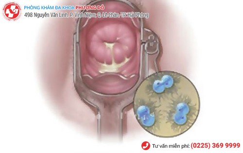 Bệnh lậu ở nữ