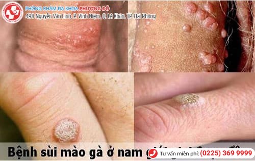 Mụn ở âm đạo là bệnh gì?