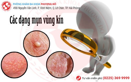 Các dạng mụn vùng kín