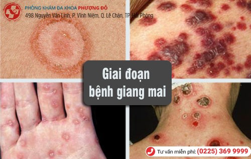 Các giai đoạn bệnh giang mai