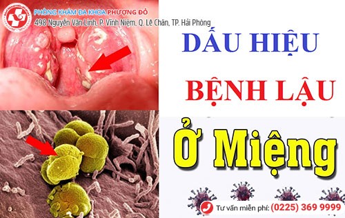 Hình ảnh bệnh lậu ở miệng