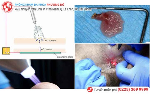 Đốt sùi mào gà - 1 phương pháp chữa sùi mào gà