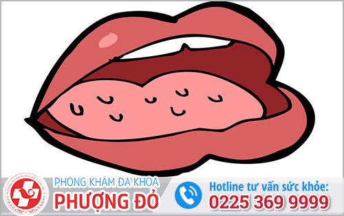 Nổi hạt trắng, hồng ở lưỡi có thể là bệnh herpes miệng