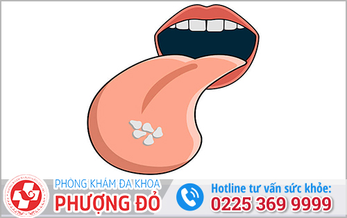Lưỡi Xuất Hiện Hạt Sần Nhỏ