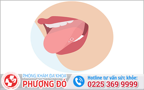 Bệnh sùi mào gà khiến bệnh nhân xuất hiện các hạt sần nhỏ ở lưỡi