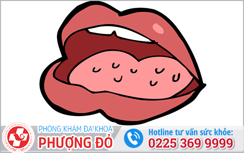 Miệng Và Lưỡi Nổi Mụn Thịt