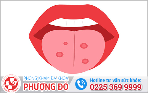 Bệnh giang mai ở khoang miệng gây nổi mụn thịt