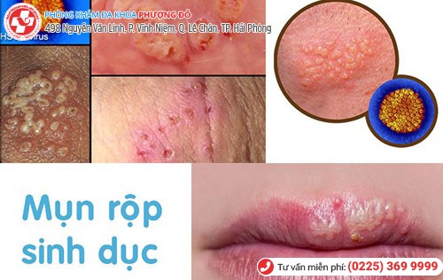 Mụn rộp sinh dục ở miệng