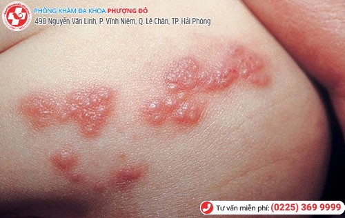 Mụn rộp sinh dục 1