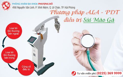 ALA - PDT - phương pháp chữa sùi mào gà hiệu quả