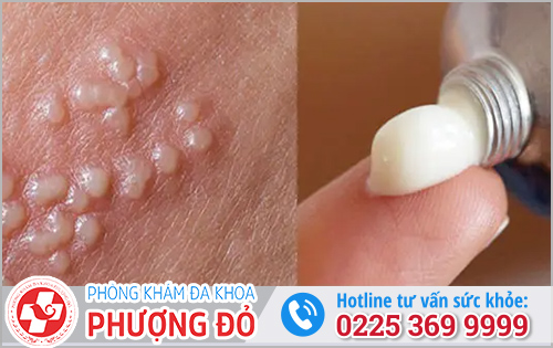 Thuốc bôi mụn rộp sinh dục